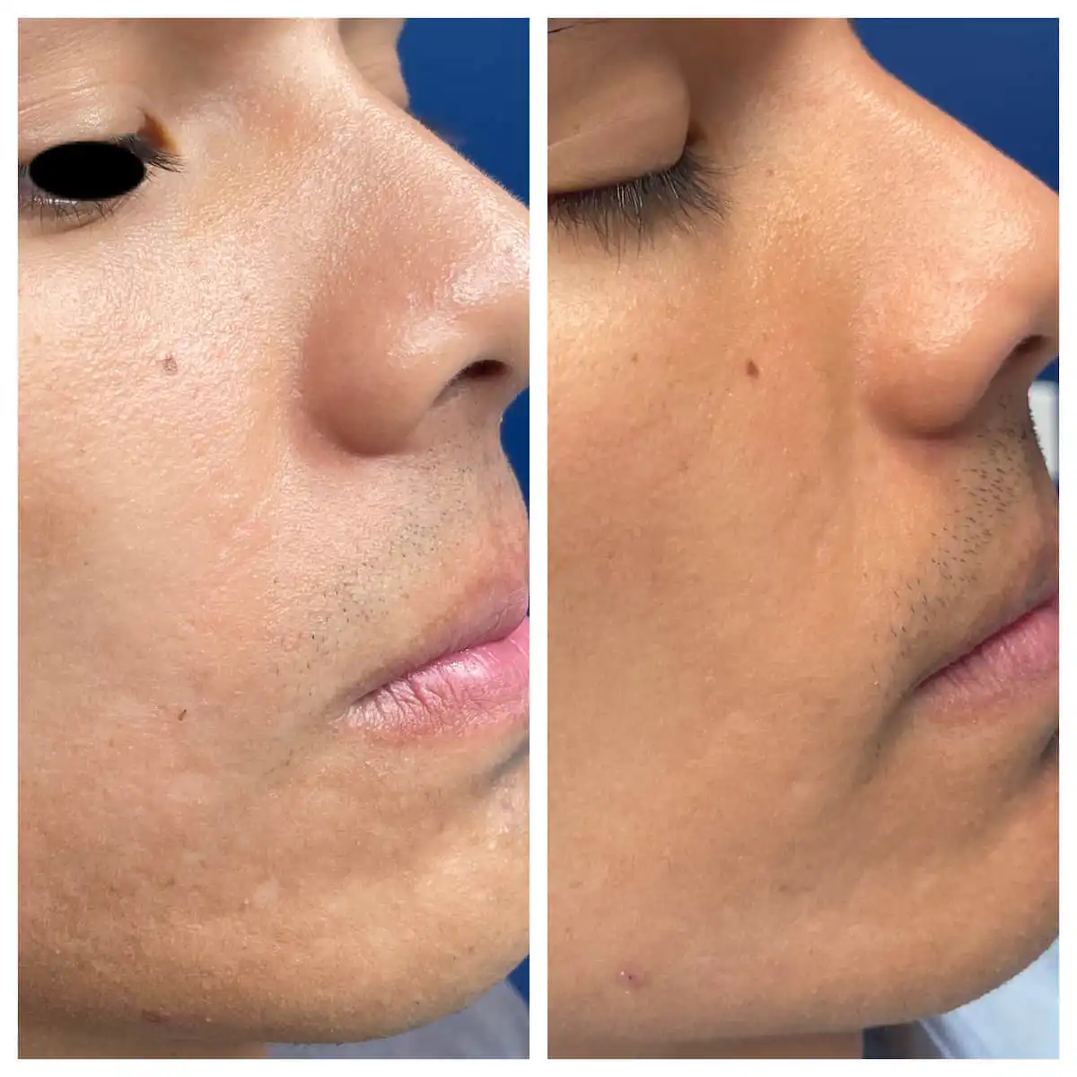 Acne scar treatment with subcision and TCA CROSS before and after, additional view — St. Louis Dermatology & Cosmetic Surgery