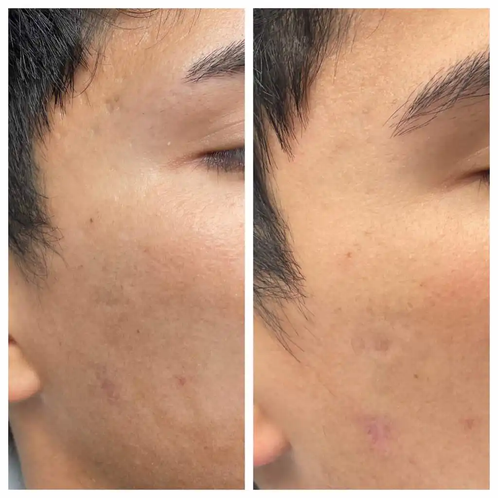 acne-scar-treatment (4)