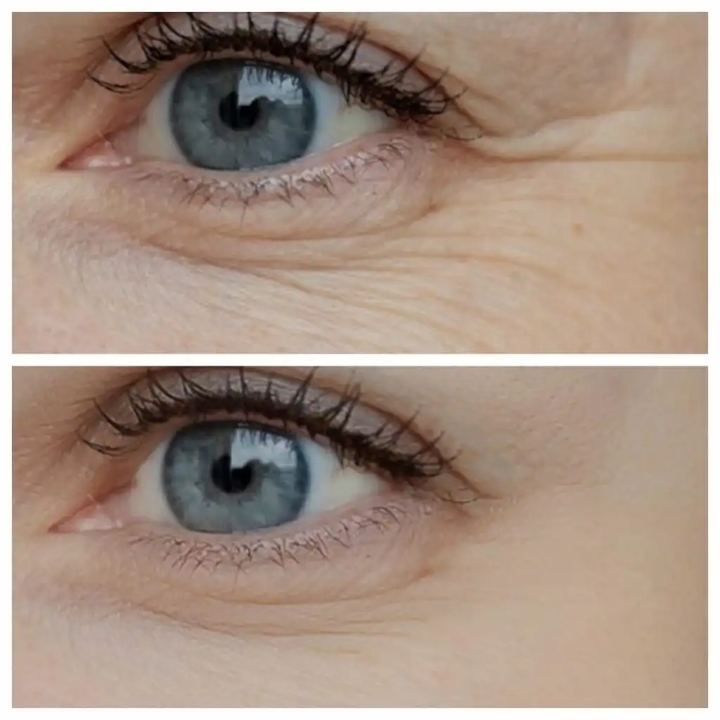 Botox before and after around the eyes, patient of Dr. Brandon T. Beal