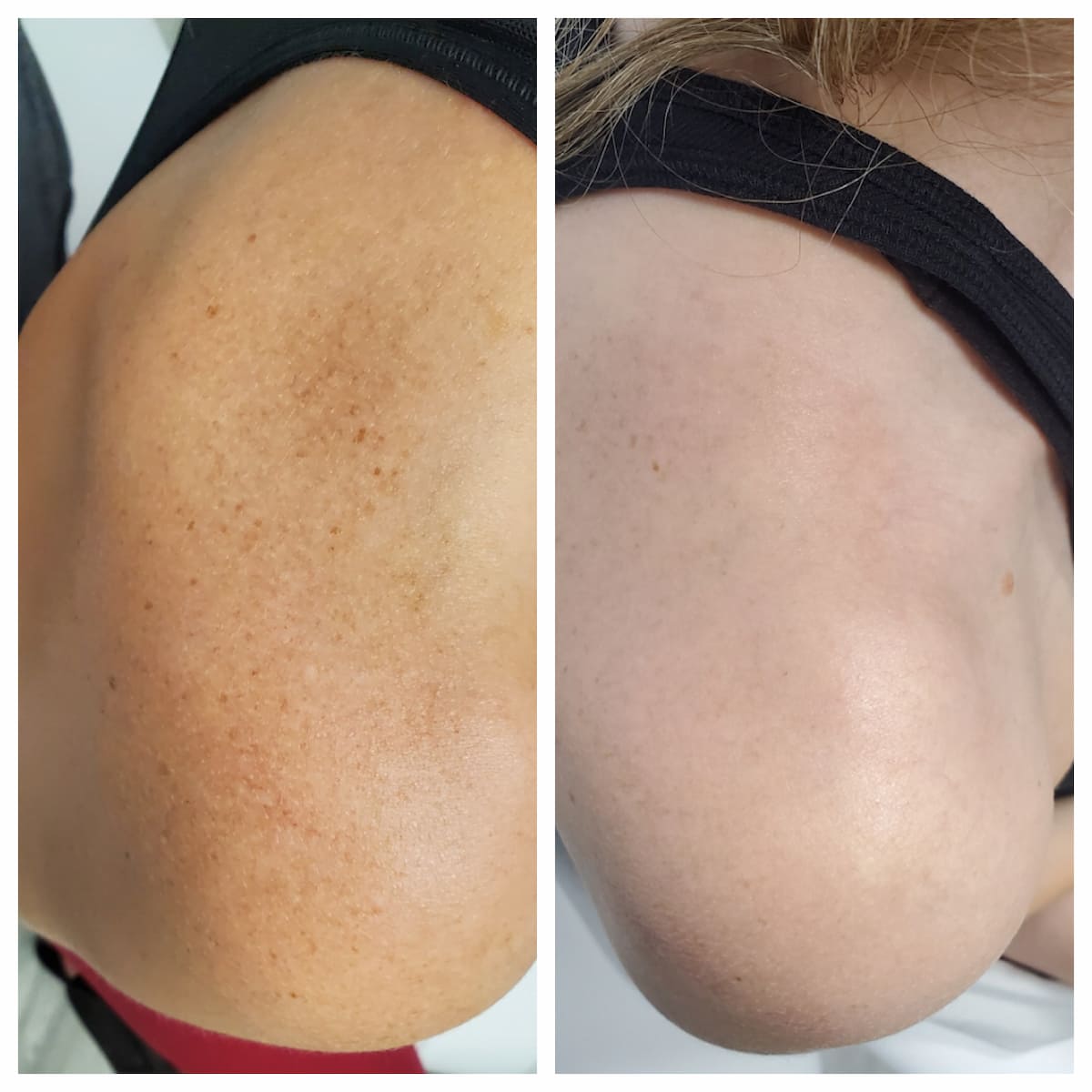 IPL for brown spots on the shoulder before and after — St. Louis Dermatology & Cosmetic Surgery