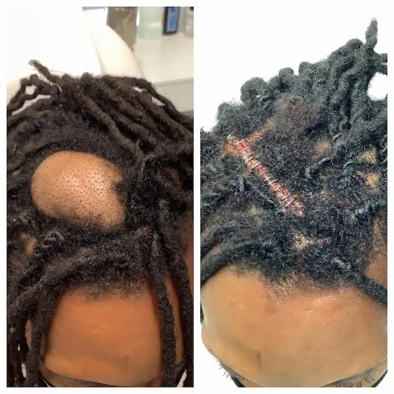 cyst-removal (2)