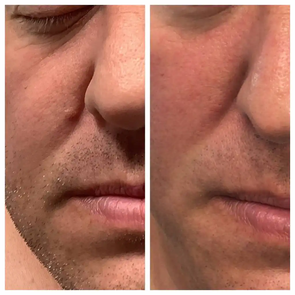 dermatologist-mole-removal
