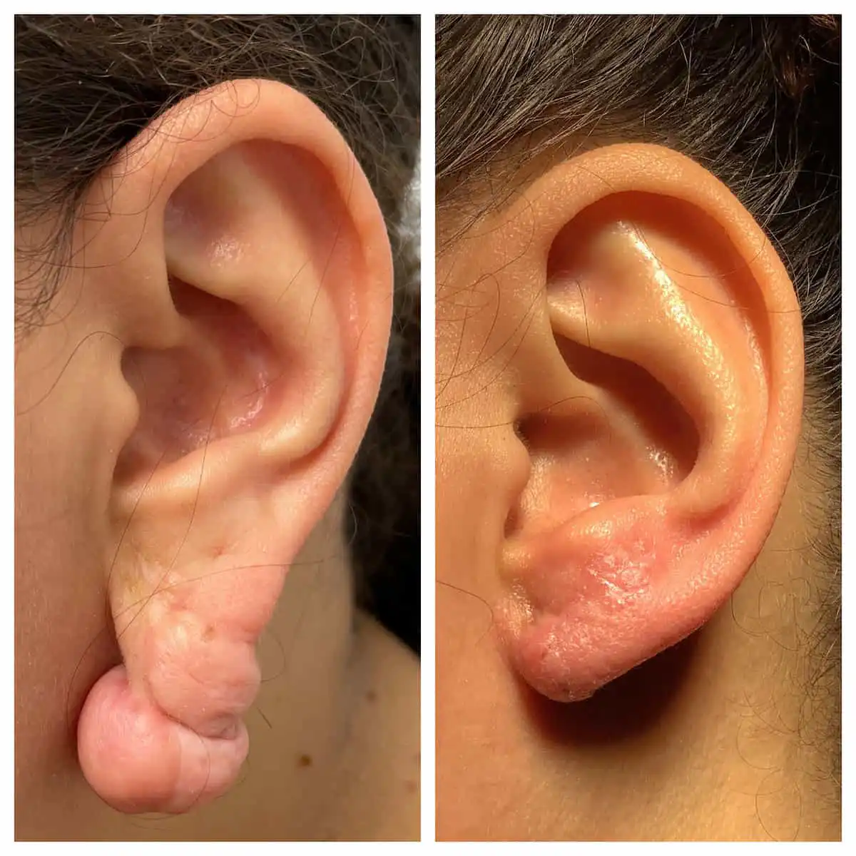 Ear surgery before and after — St. Louis Dermatology & Cosmetic Surgery