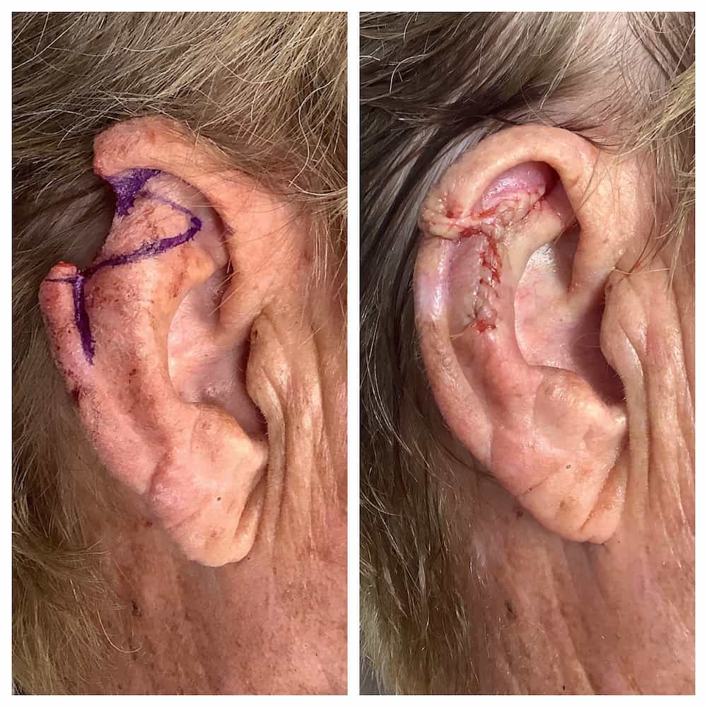 ear-surgery-before-and-after (3)
