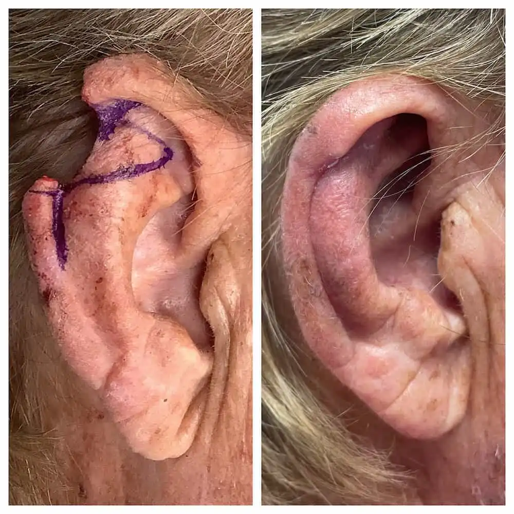 ear-surgery-before-and-after (4)