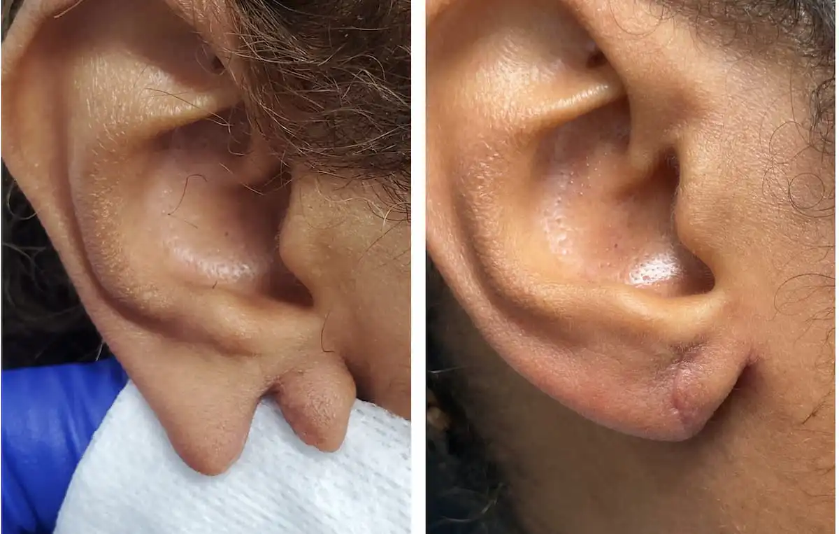 Split earlobe repair before and after — St. Louis Dermatology & Cosmetic Surgery
