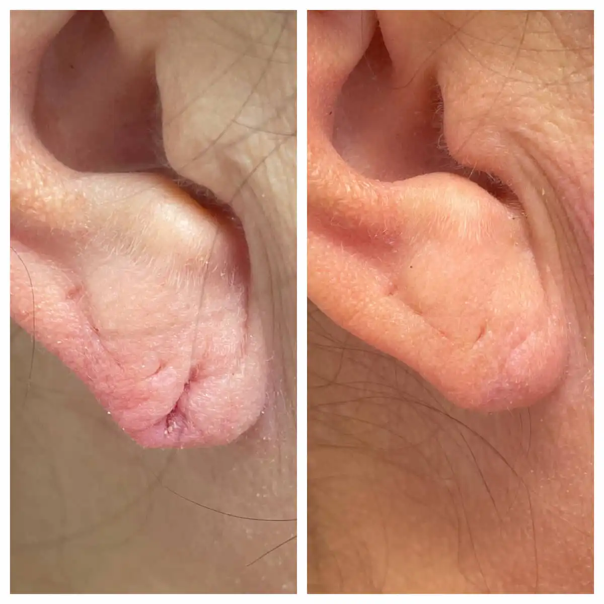 Stretched earlobe repair before and after — St. Louis Dermatology & Cosmetic Surgery