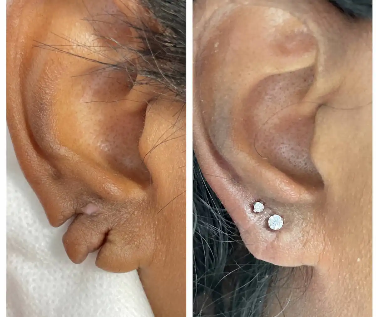 Torn earlobe repair before and after — St. Louis Dermatology & Cosmetic Surgery
