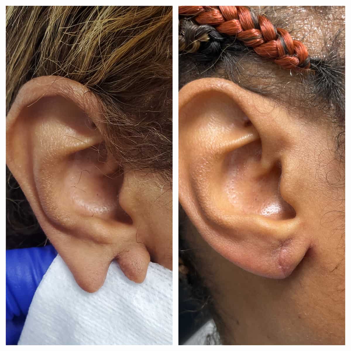 earlobe-repair (2)