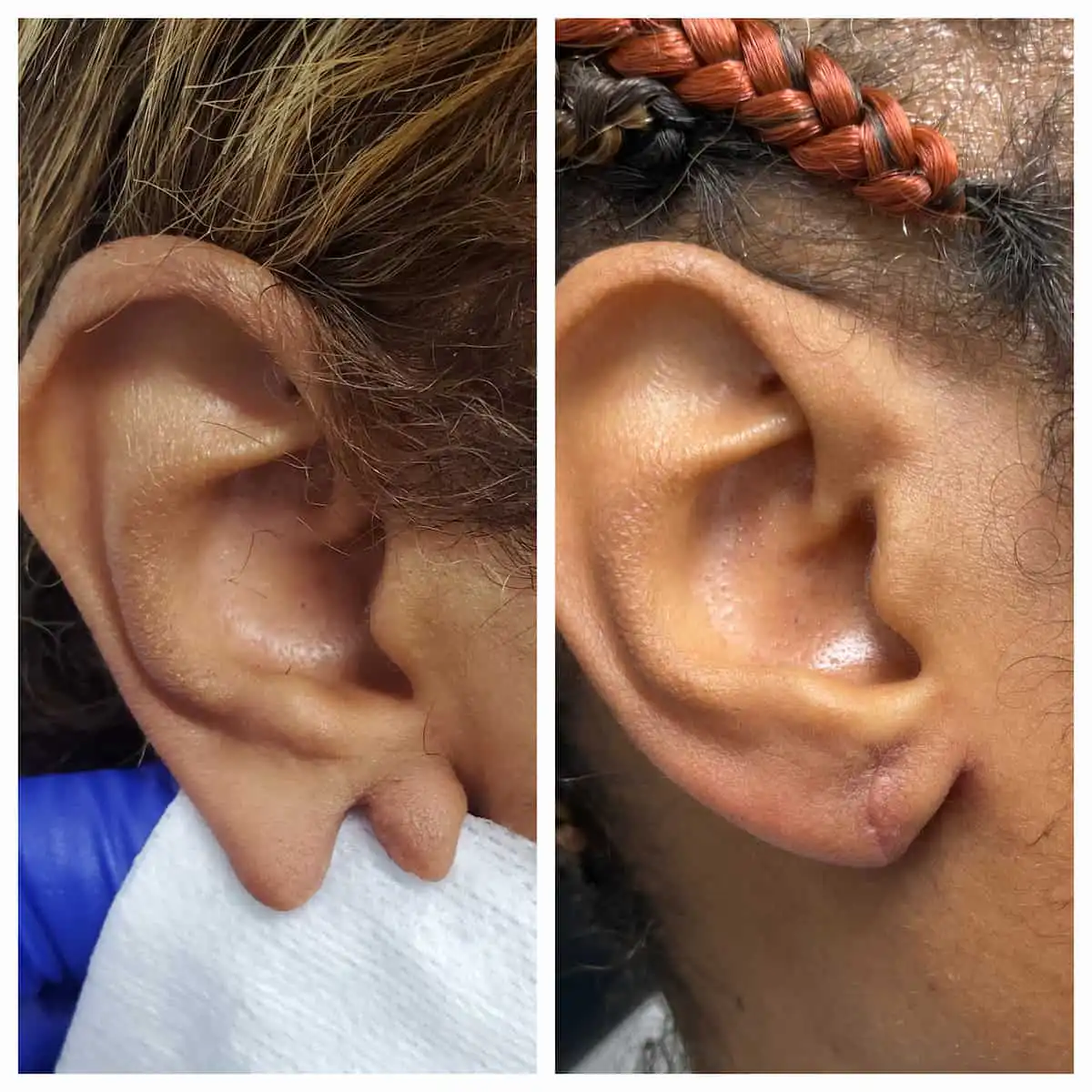 Earlobe repair before and after — St. Louis Dermatology & Cosmetic Surgery