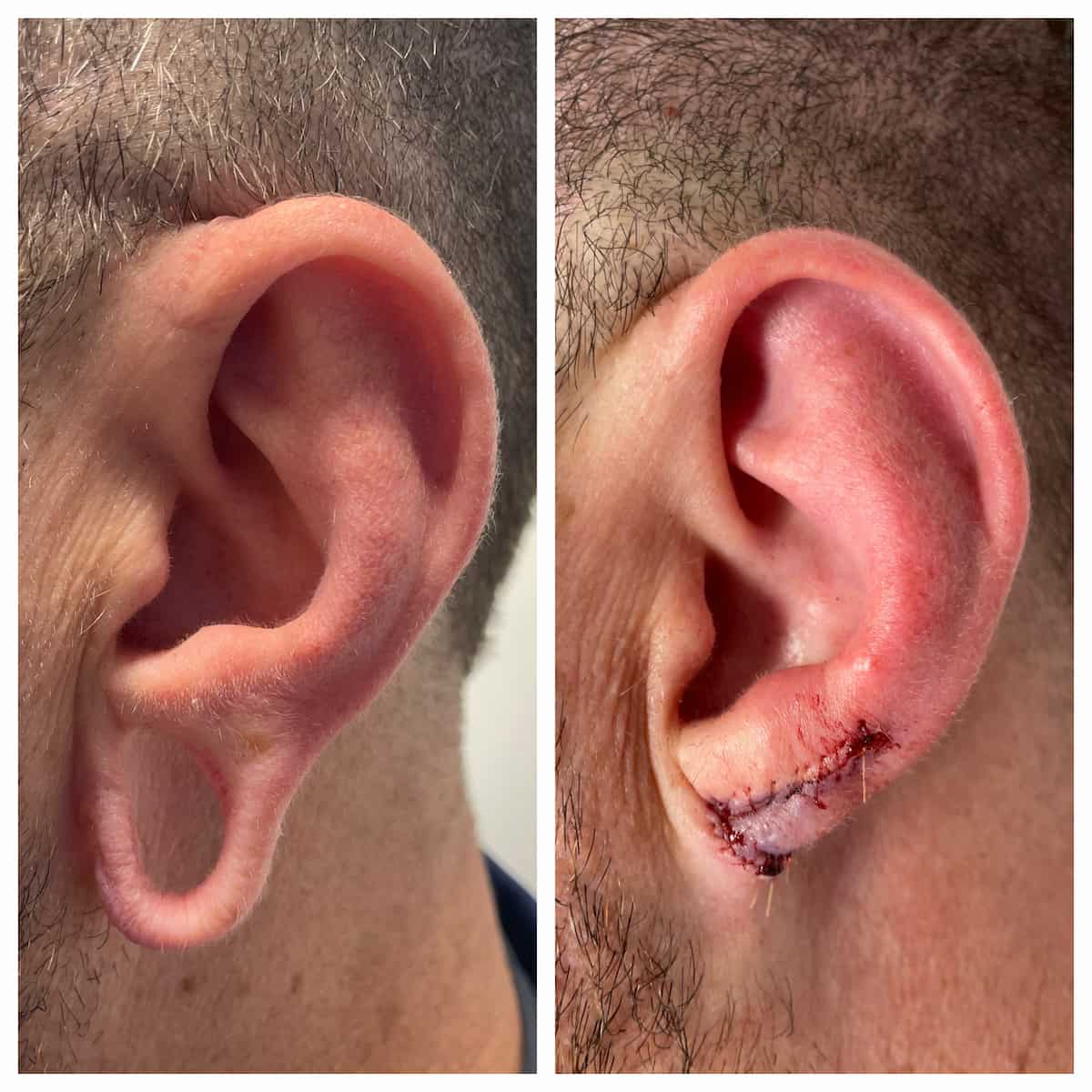 earlobe-repair (3)