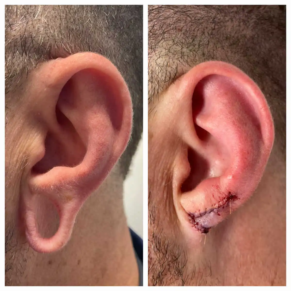 Earlobe repair before and after — St. Louis Dermatology & Cosmetic Surgery