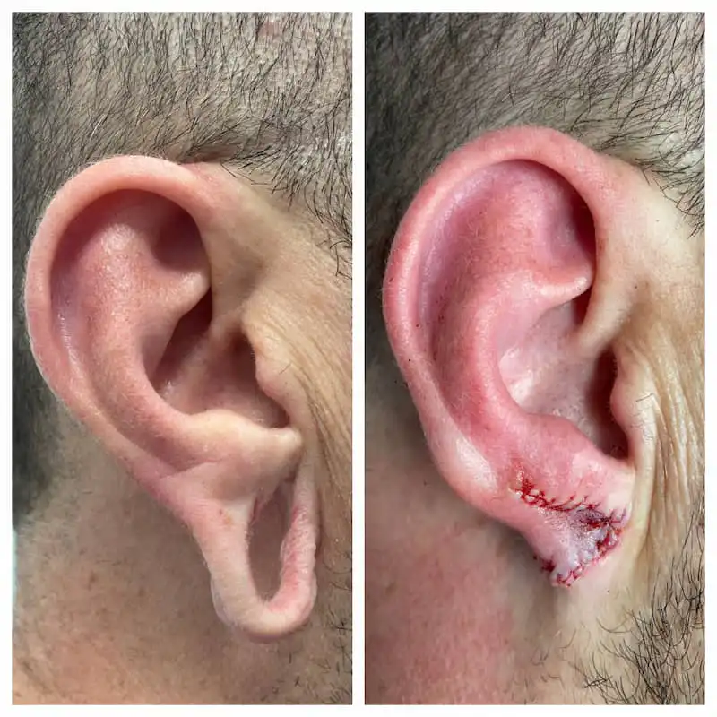 Earlobe repair before and after — St. Louis Dermatology & Cosmetic Surgery
