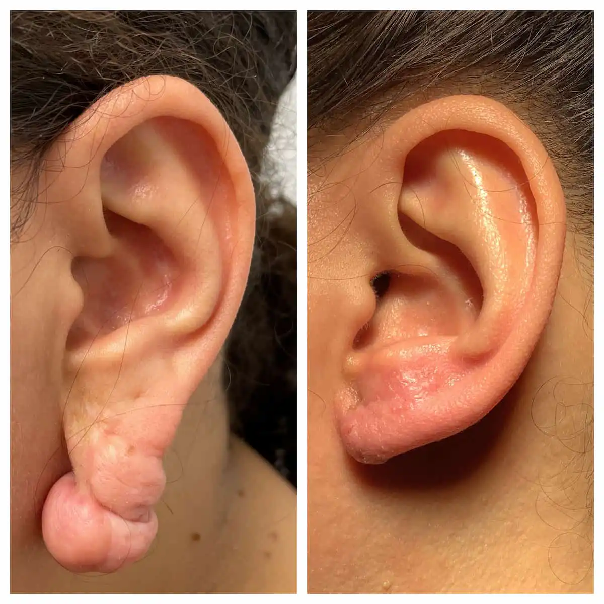 Earlobe repair before and after — St. Louis Dermatology & Cosmetic Surgery