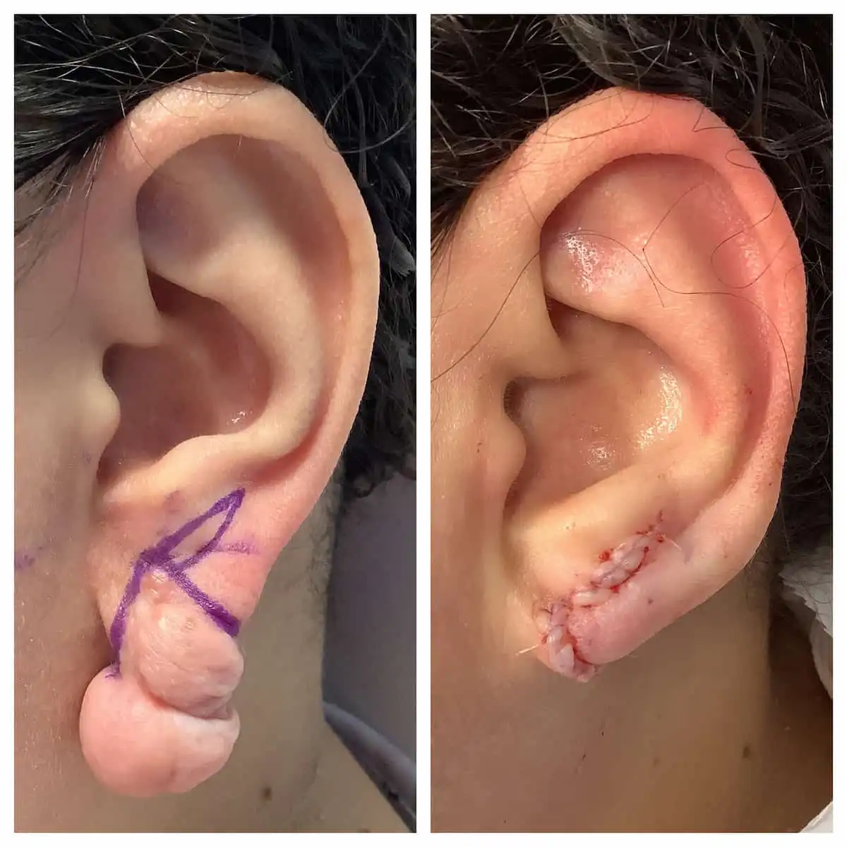 Earlobe repair before and after, with surgical planning — St. Louis Dermatology & Cosmetic Surgery