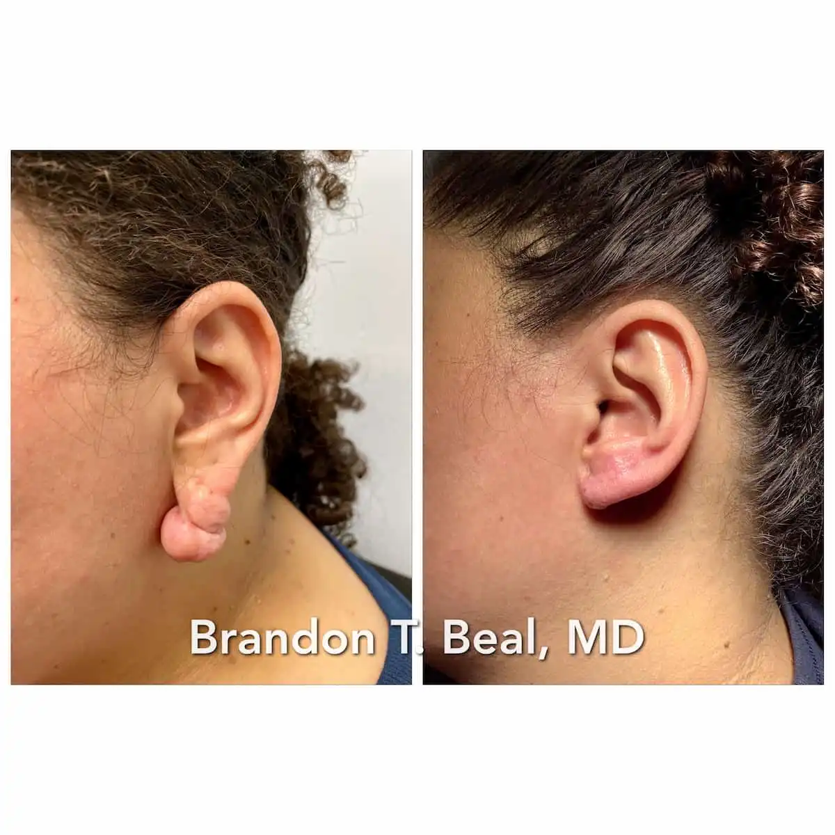 Earlobe repair before and after — St. Louis Dermatology & Cosmetic Surgery
