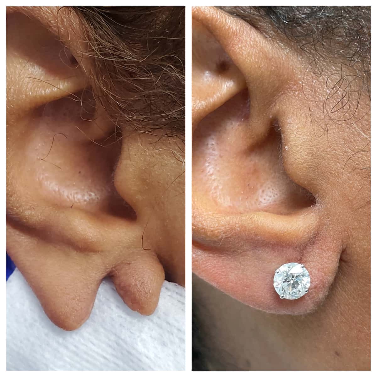 earlobe-repair (8)