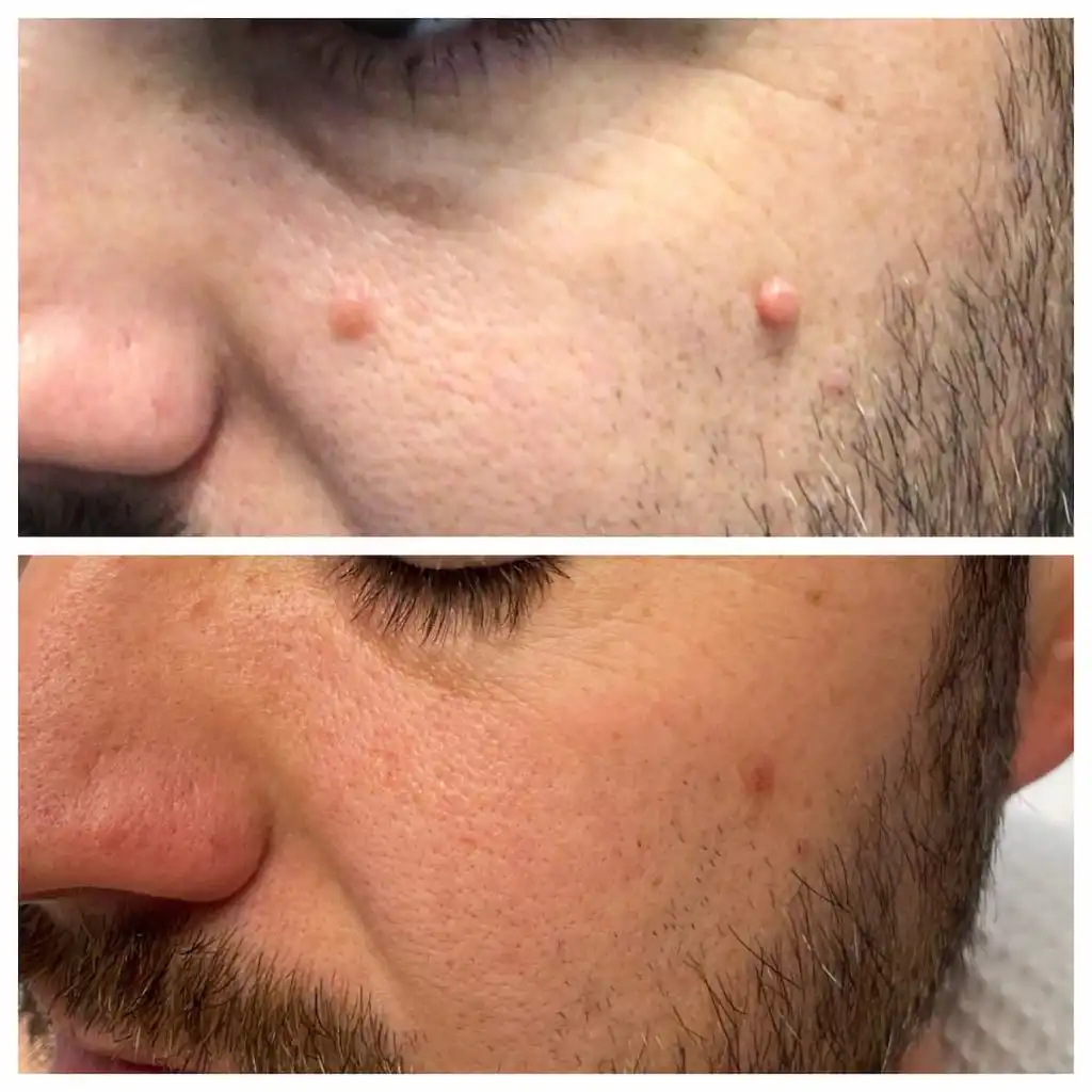 face-mole-removal