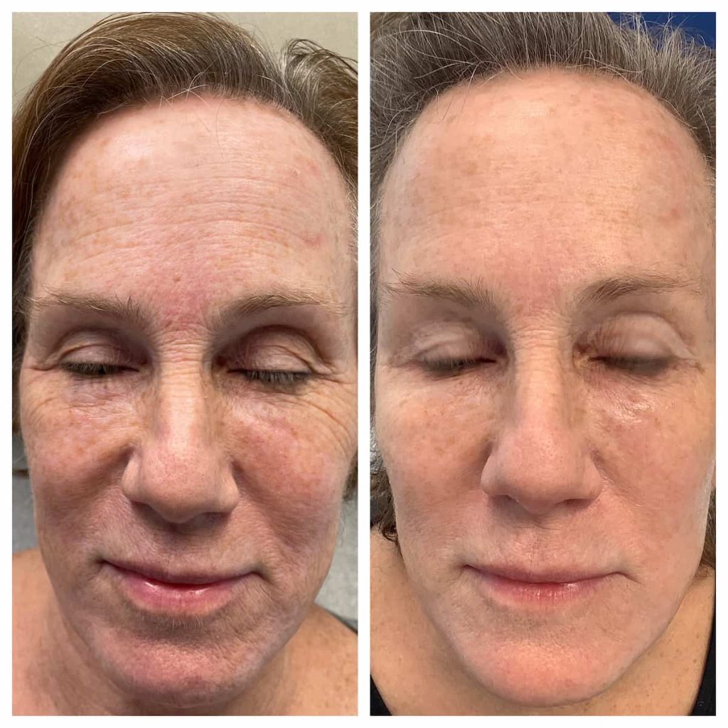 Comprehensive Facial Rejuvenation Before And After St Louis Dermatology And Cosmetic Surgery 2158
