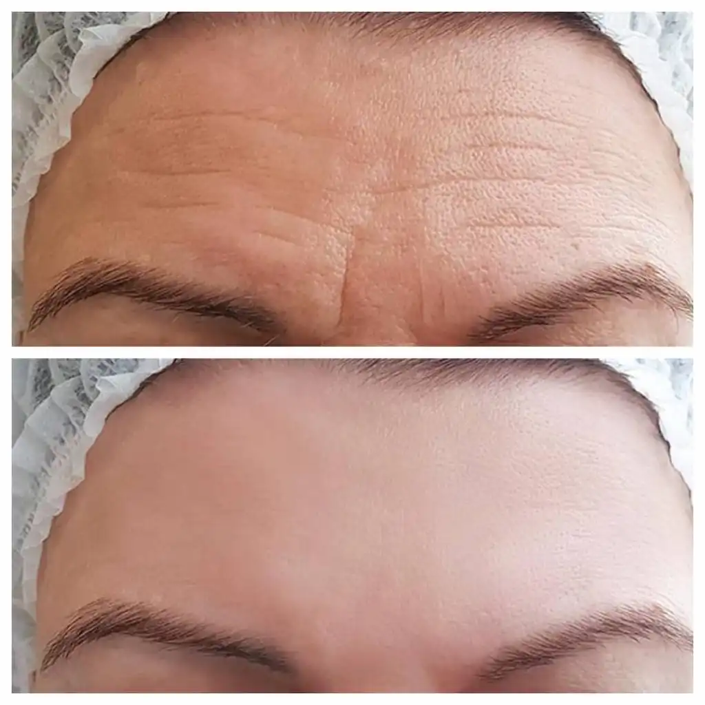 forehead-botox-before-and-after