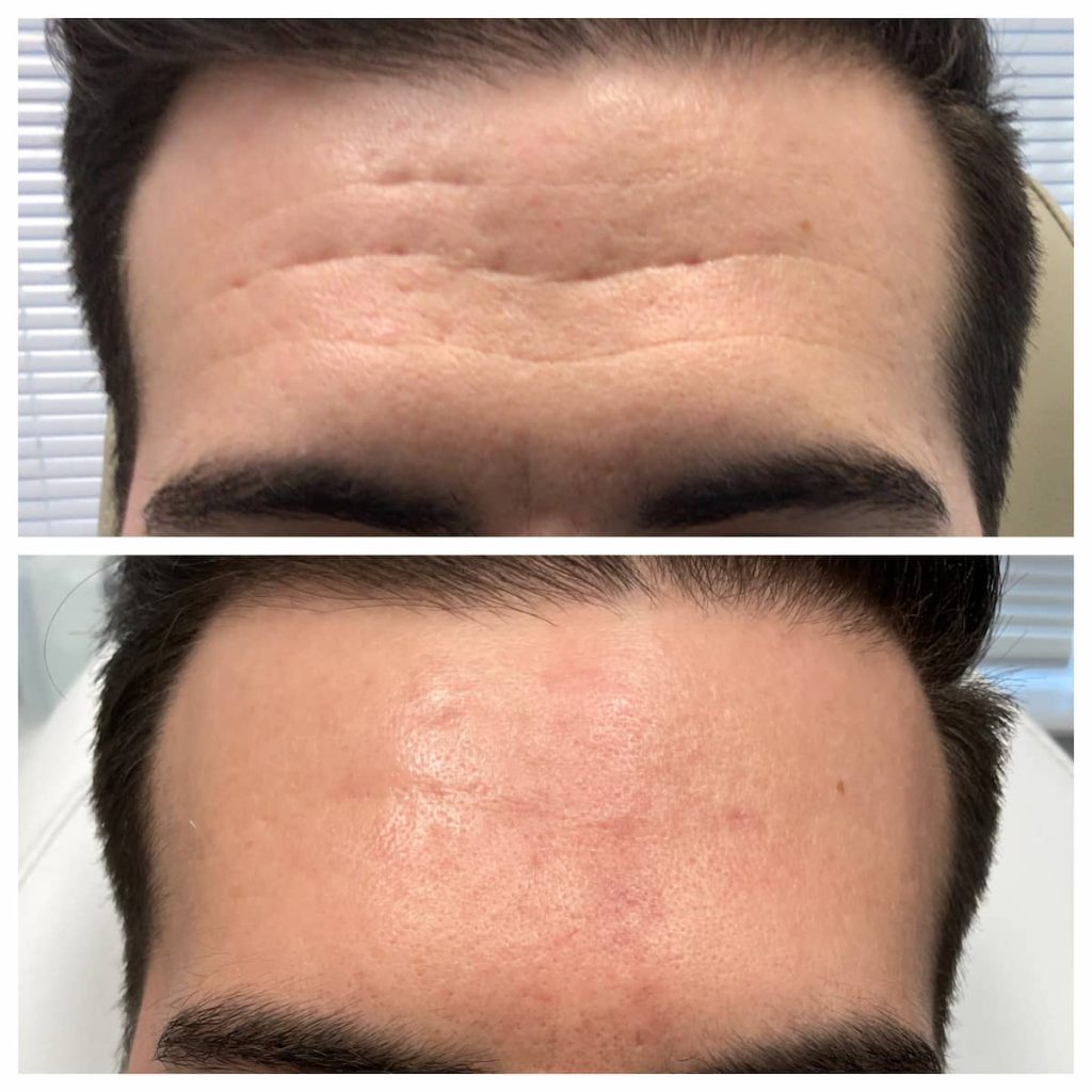 Forehead Wrinkles Before and After St. Louis Dermatology & Cosmetic