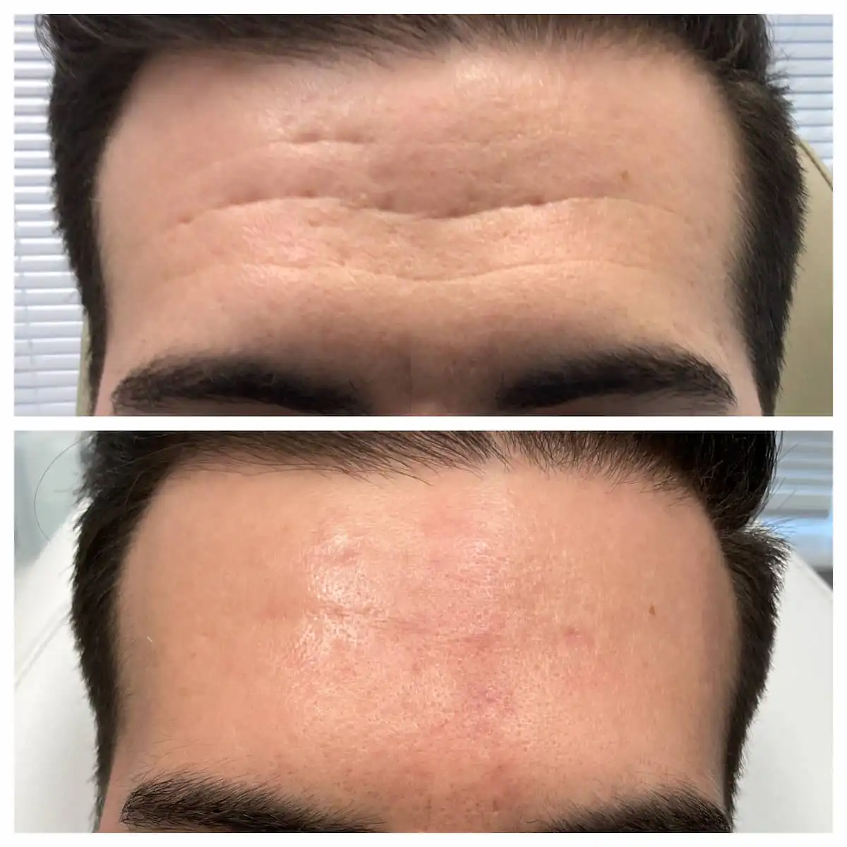 Forehead filler before and after — St. Louis Dermatology & Cosmetic Surgery