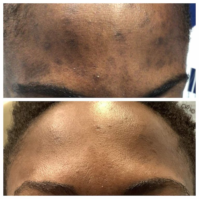 African American Hyperpigmentation Before And After St. Louis