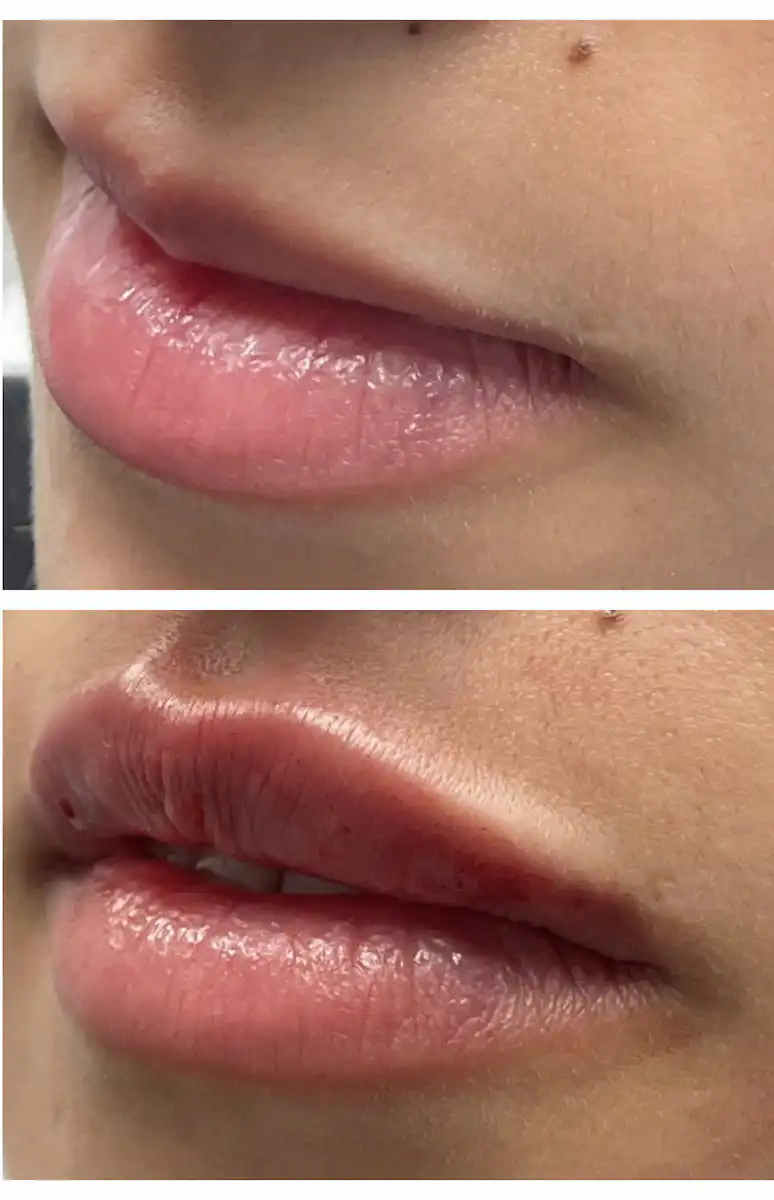 Lip filler before and after, oblique view — St. Louis Dermatology & Cosmetic Surgery