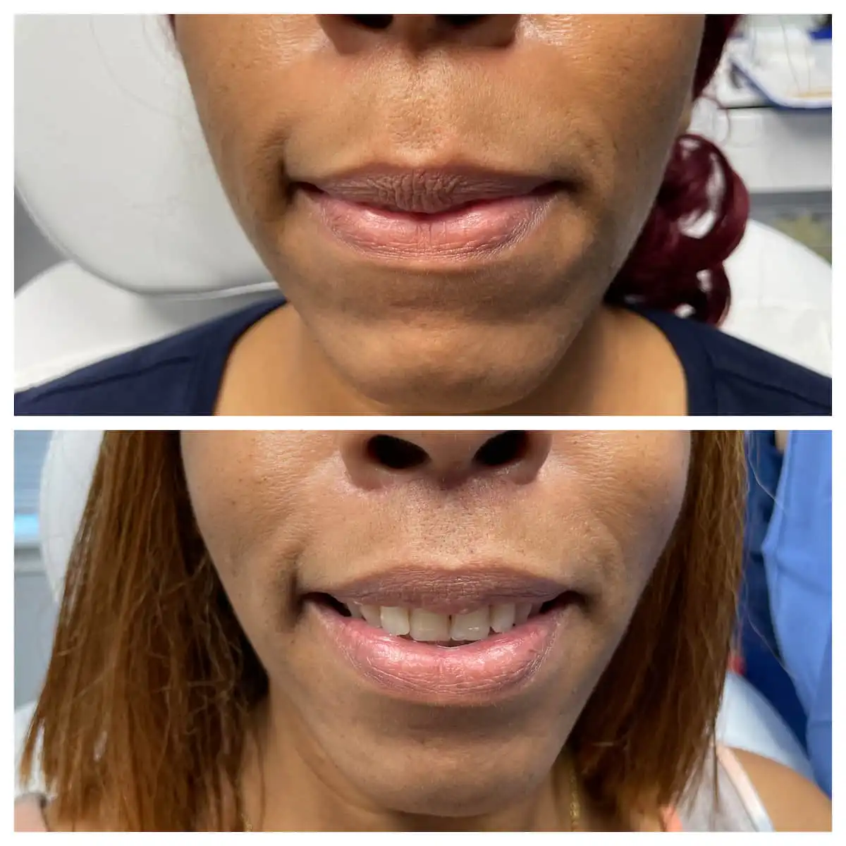 Lip lift before and after, front view — St. Louis Dermatology & Cosmetic Surgery