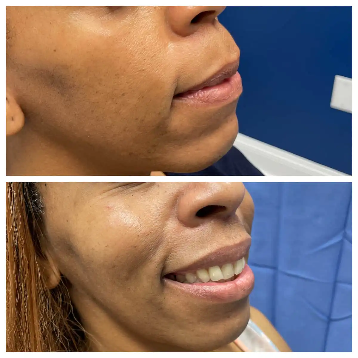 Lip lift before and after, oblique view — St. Louis Dermatology & Cosmetic Surgery