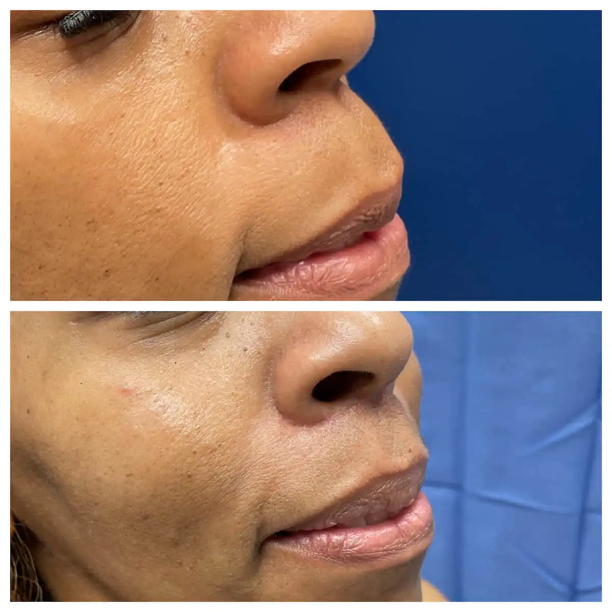 Lip lift before and after, oblique view — St. Louis Dermatology & Cosmetic Surgery