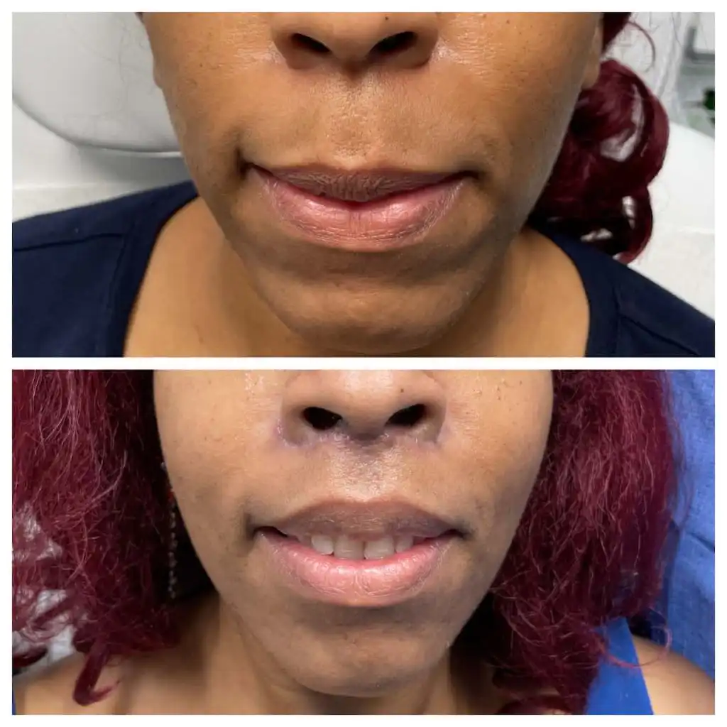 Lip lift before and after, front view — St. Louis Dermatology & Cosmetic Surgery