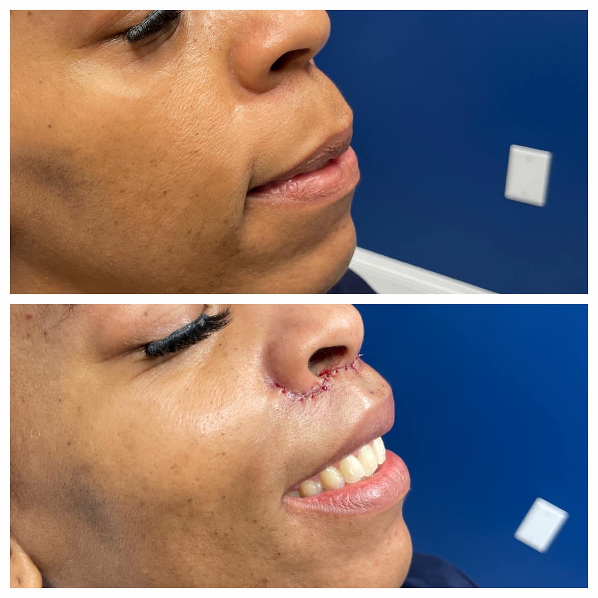 lip-lift-before-and-after (2)