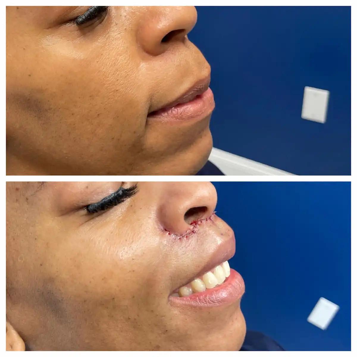 Lip lift before and after, close view — St. Louis Dermatology & Cosmetic Surgery