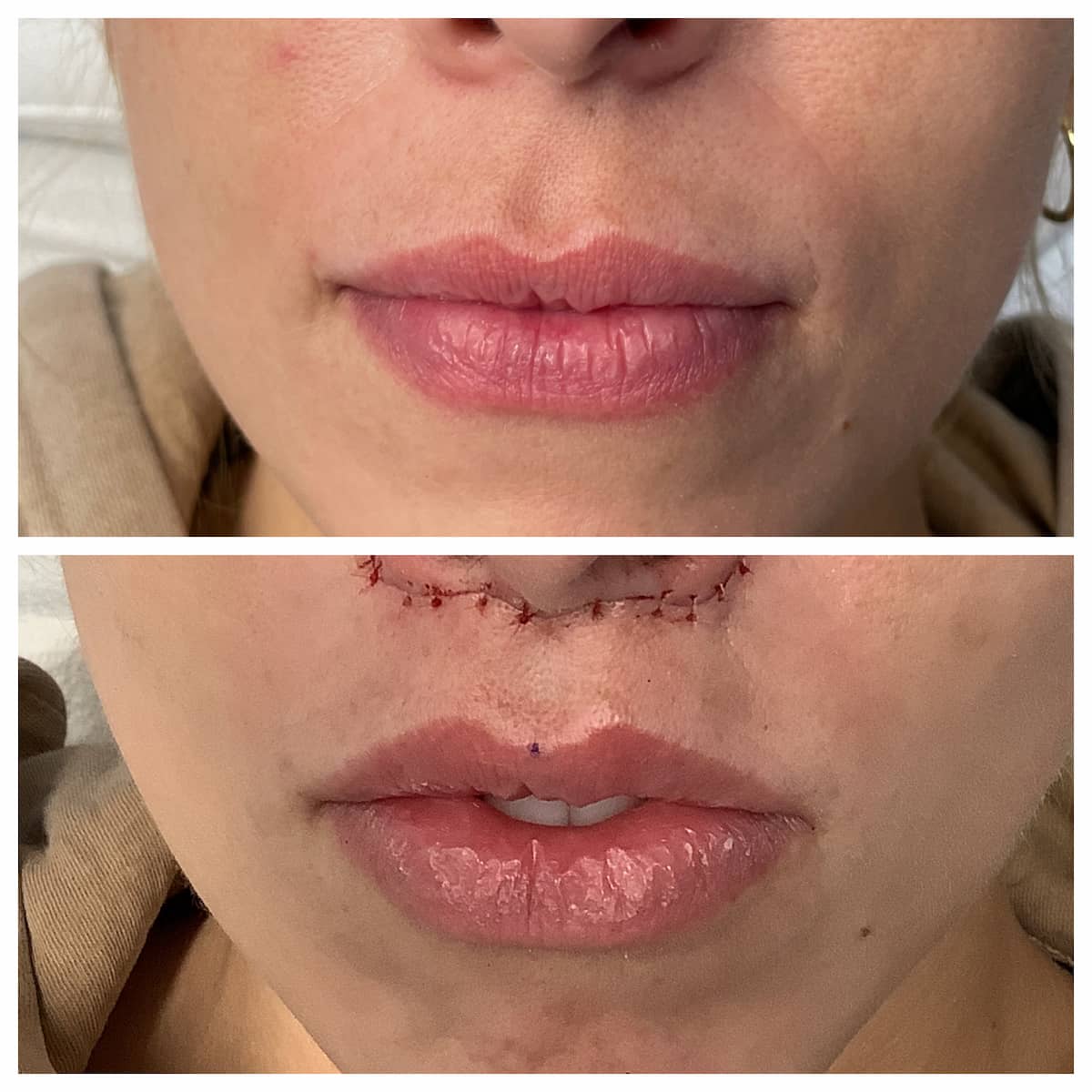 lip-lift-before-and-after (4)