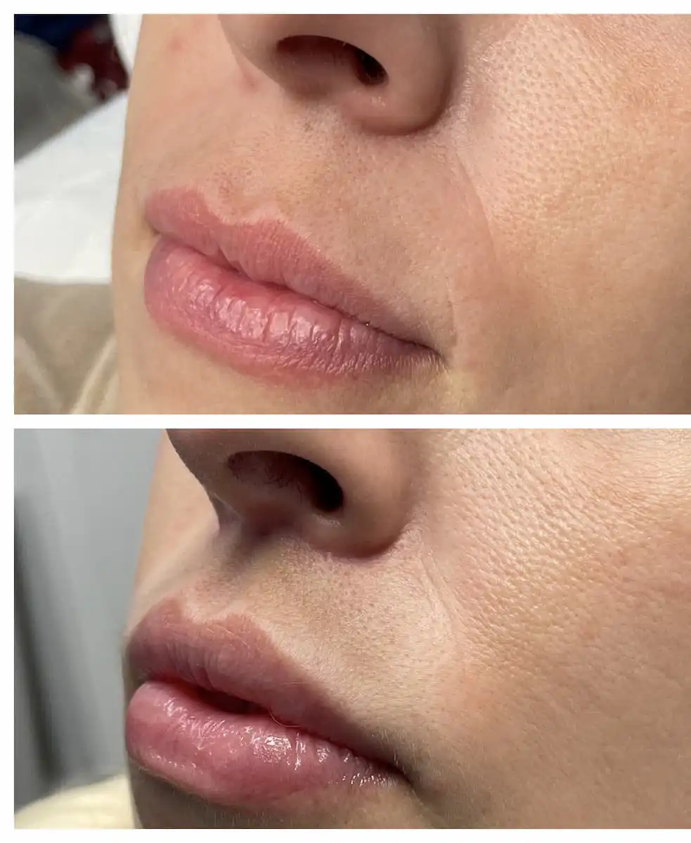 Lip lift before and after, side view — St. Louis Dermatology & Cosmetic Surgery
