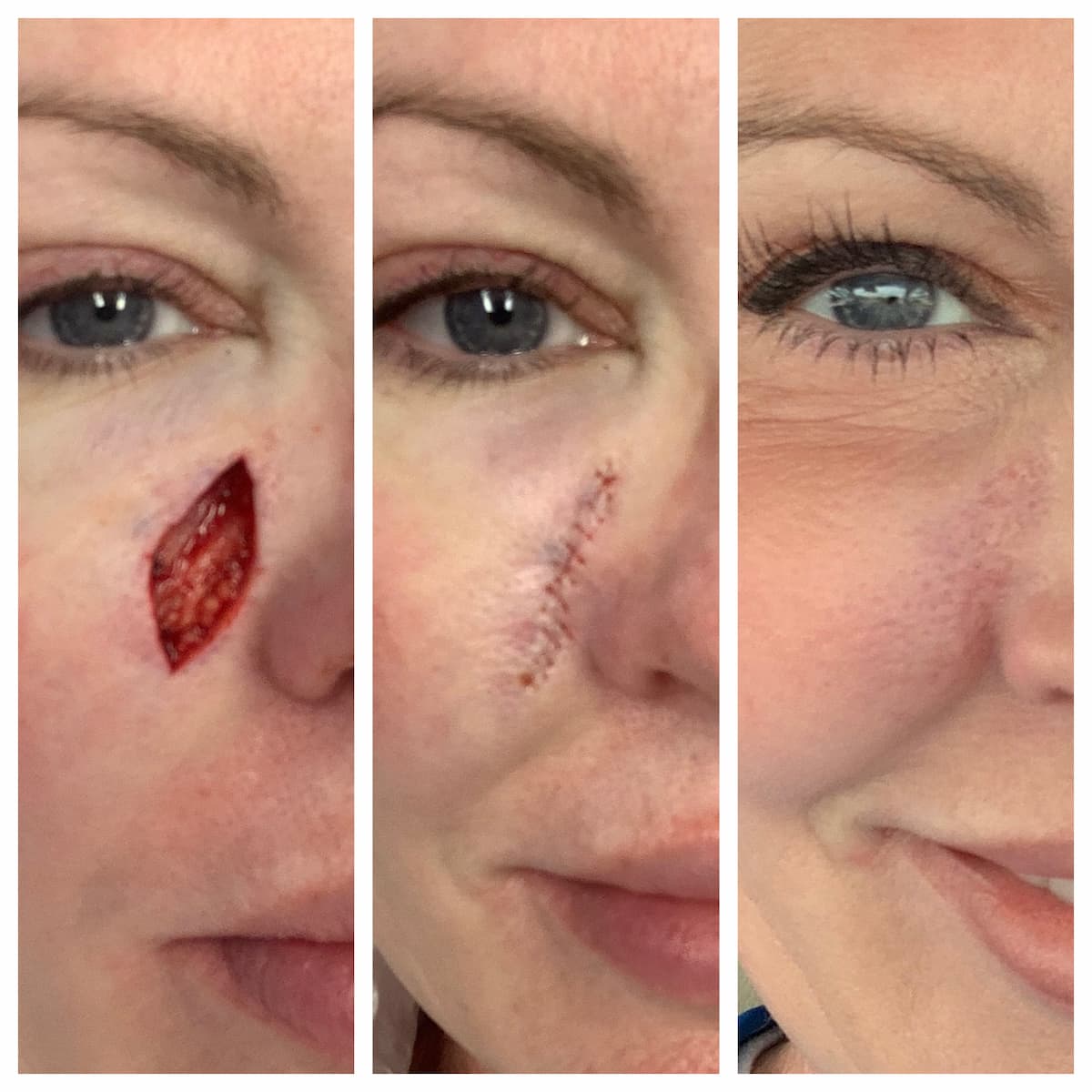 Cheek Mohs surgery and reconstruction, surgical stages — St. Louis Dermatology & Cosmetic Surgery