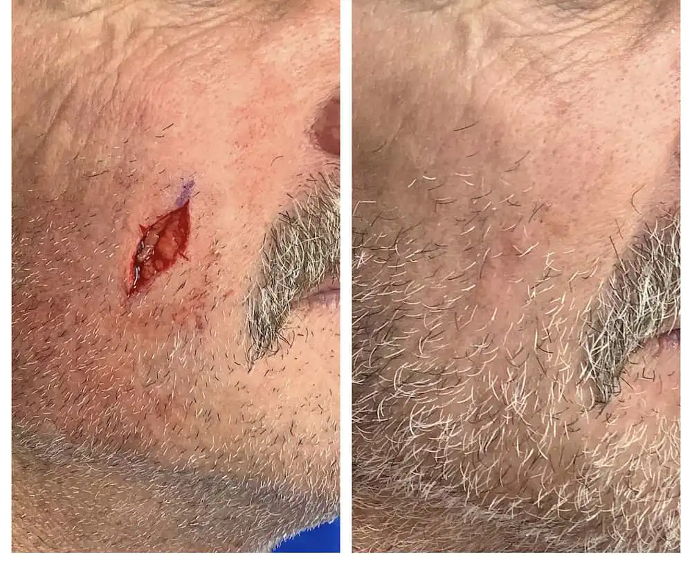Cheek Mohs surgery and reconstruction, before and after — St. Louis Dermatology & Cosmetic Surgery