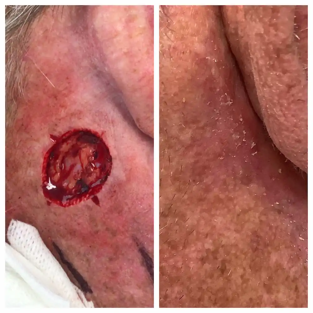 Cheek skin cancer Mohs surgery defect and healed result — St. Louis Dermatology & Cosmetic Surgery