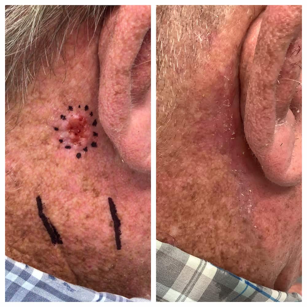 mohs-surgery-neck-before-and-after