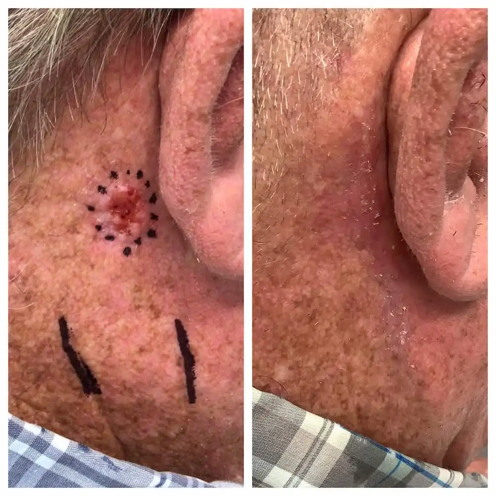 Neck Mohs surgery and reconstruction, before and after — St. Louis Dermatology & Cosmetic Surgery