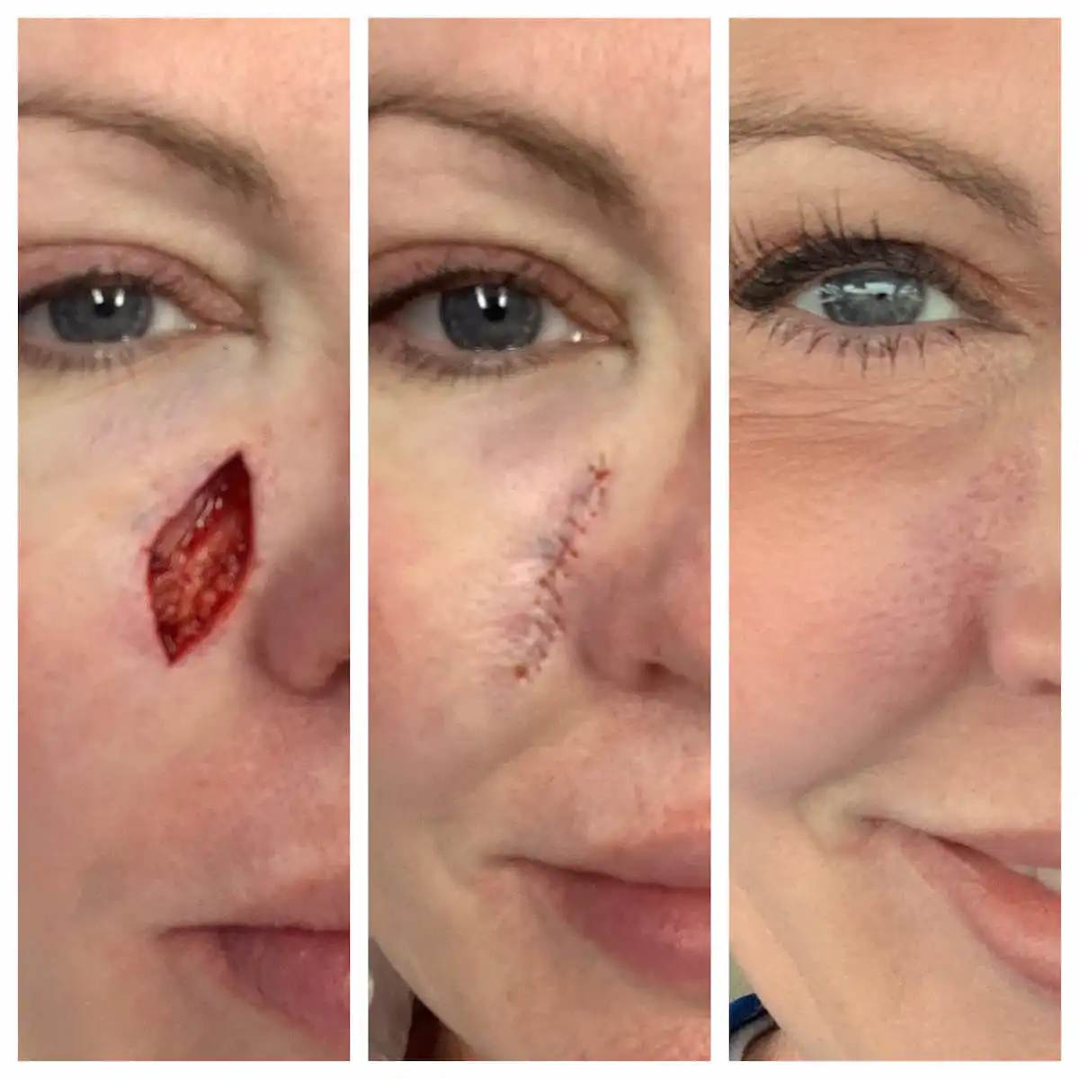 Cheek Mohs surgery and reconstruction, surgical stages — St. Louis Dermatology & Cosmetic Surgery