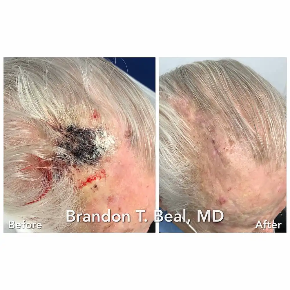 Scalp skin cancer Mohs surgery and reconstruction, before and after — St. Louis Dermatology & Cosmetic Surgery