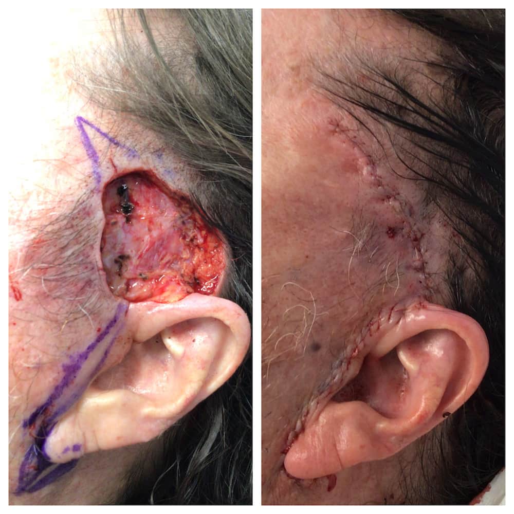 mohs-surgery-temple-before-and-after (1)
