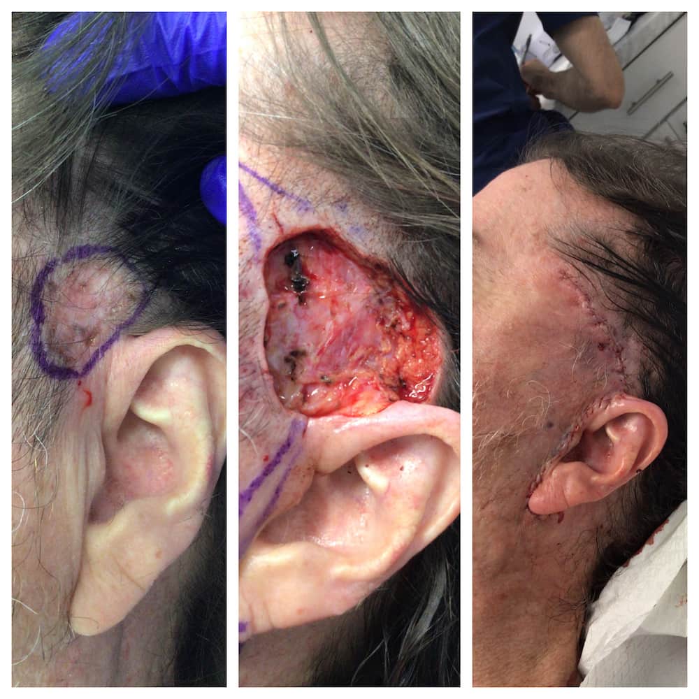 Temple Mohs surgery and reconstruction, surgical stages — St. Louis Dermatology & Cosmetic Surgery