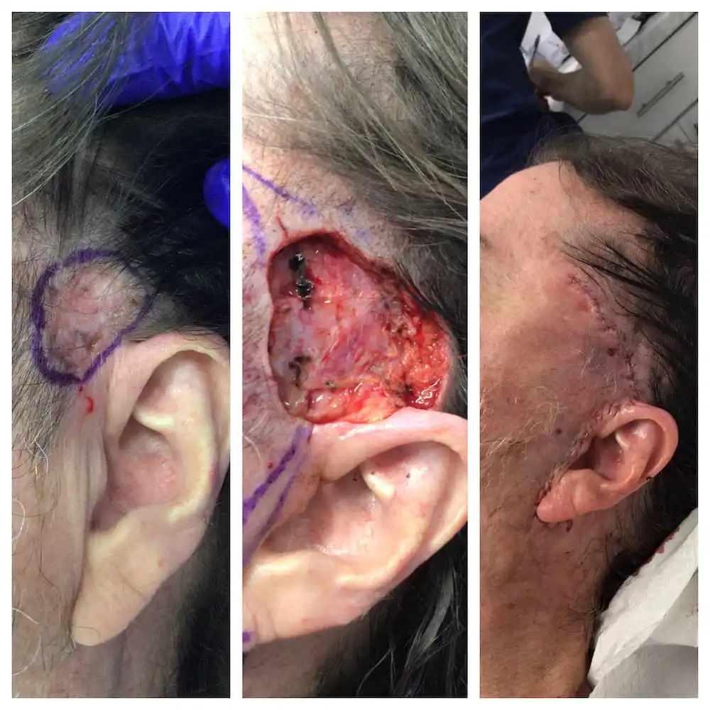 Temple Mohs surgery and reconstruction, surgical stages — St. Louis Dermatology & Cosmetic Surgery