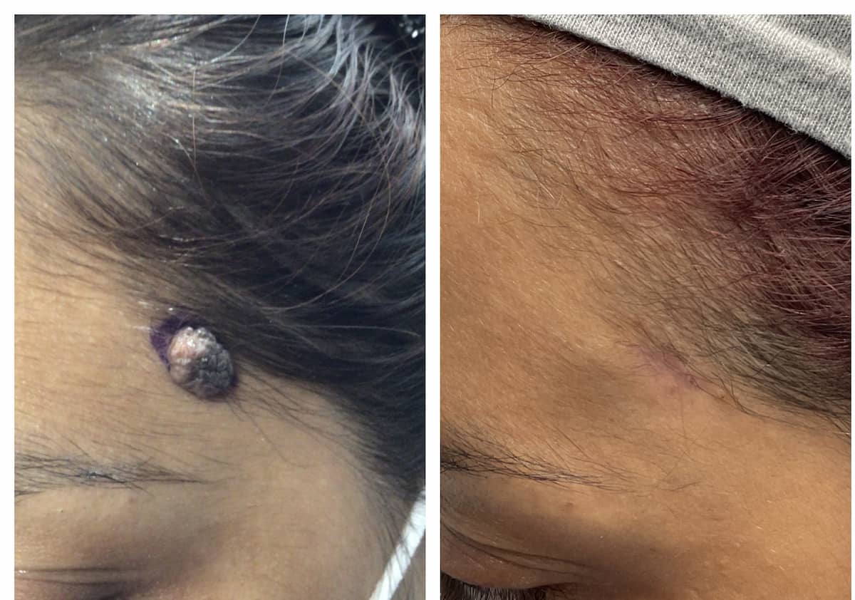 mole-removal-before-and-after