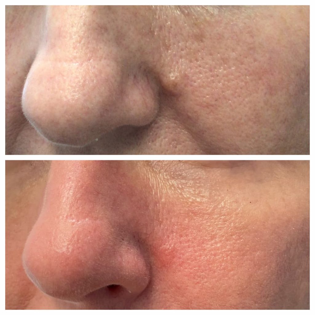 mole-removal-melting