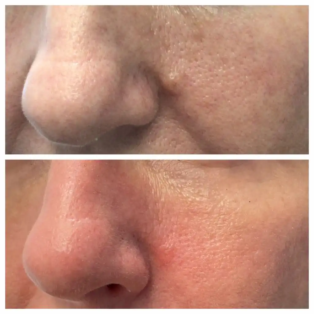 mole-removal-melting