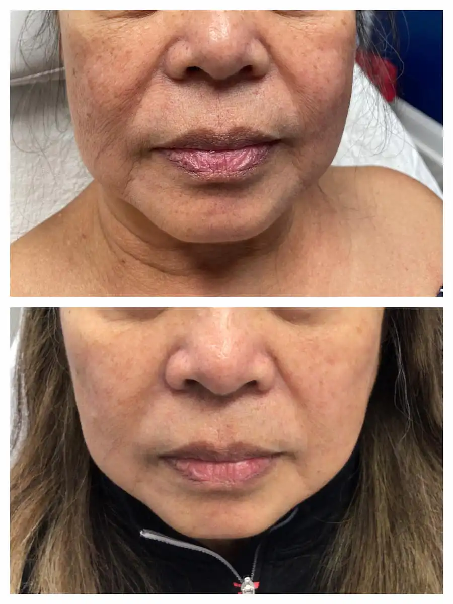 Nasolabial fold filler before and after — St. Louis Dermatology & Cosmetic Surgery